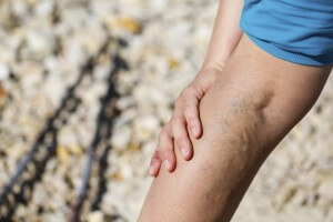 Varicose Vein Treatment