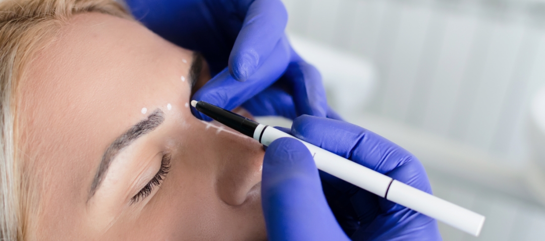 botox preparations a doctor marks out injection sites on a white woman's face with a medical marker