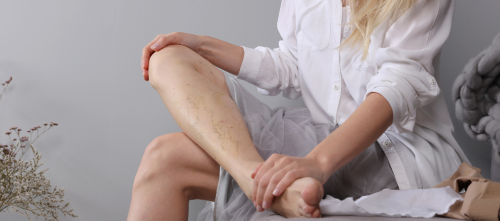 woman with spider veins on her leg